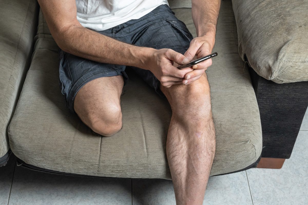 amputation claims - clinical negligence compensation