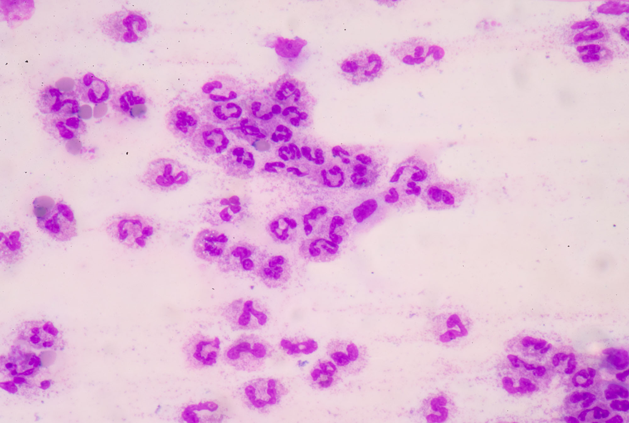 Sepsis negligence — sepsis reaction under microscope